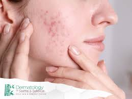 Treatment Image