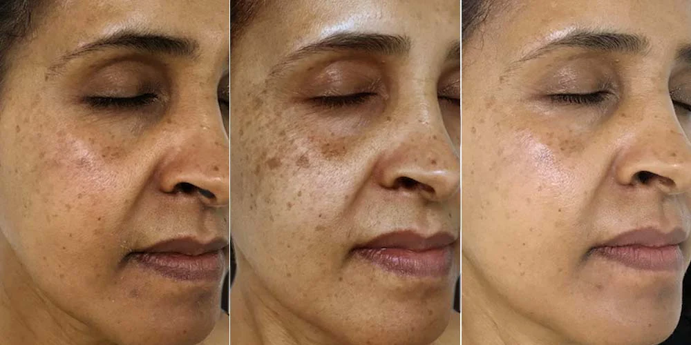Treatment Image